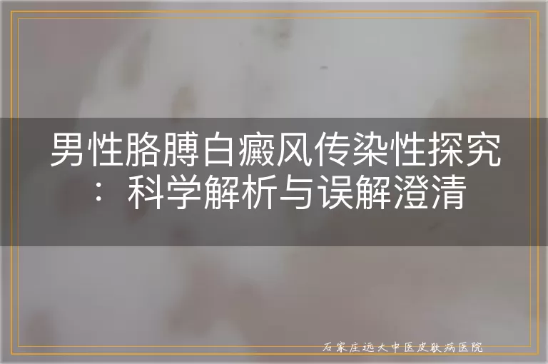 男性胳膊白癜风传染性探究：科学解析与误解澄清