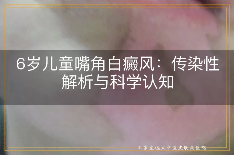 6岁儿童嘴角白癜风：传染性解析与科学认知