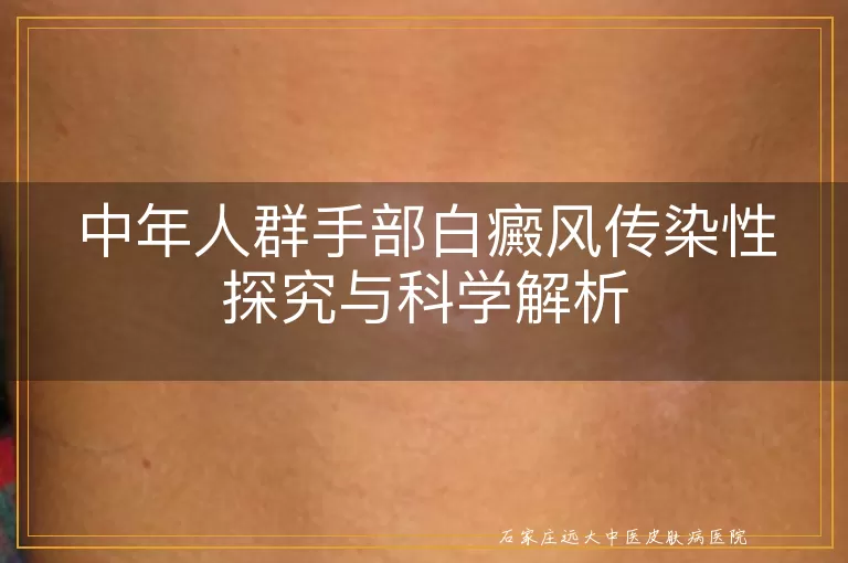 中年人群手部白癜风传染性探究与科学解析