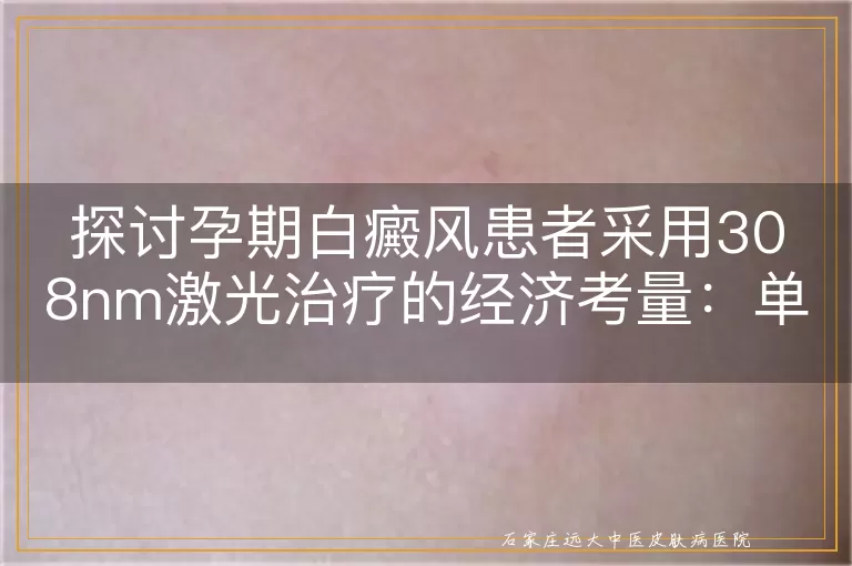 探讨孕期白癜风患者采用308nm激光治疗的经济考量：单光斑费用分析