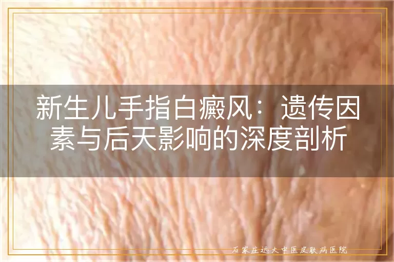 新生儿手指白癜风：遗传因素与后天影响的深度剖析