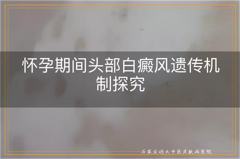 怀孕期间头部白癜风遗传机制探究