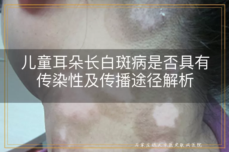 儿童耳朵长白斑病是否具有传染性及传播途径解析