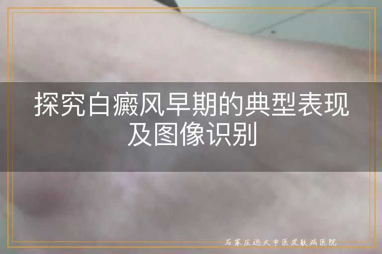 探究白癜风早期的典型表现及图像识别