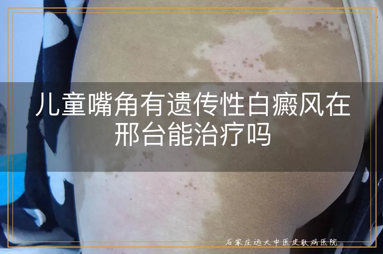 儿童嘴角有遗传性白癜风在邢台能治疗吗