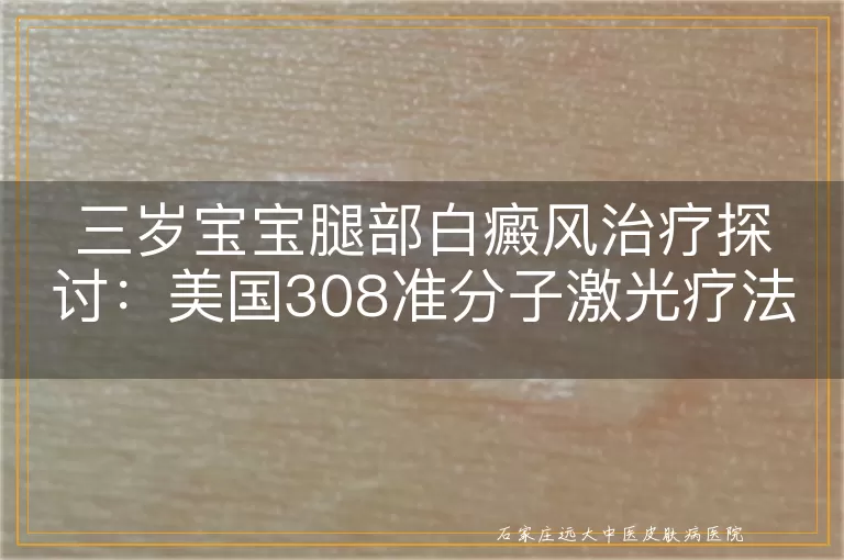 三岁宝宝腿部白癜风治疗探讨：美国308准分子激光疗法费用解析
