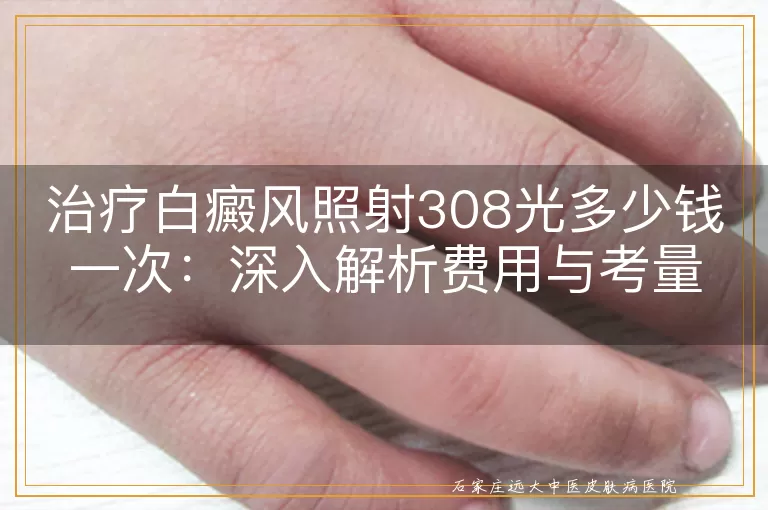 治疗白癜风照射308光多少钱一次：深入解析费用与考量因素