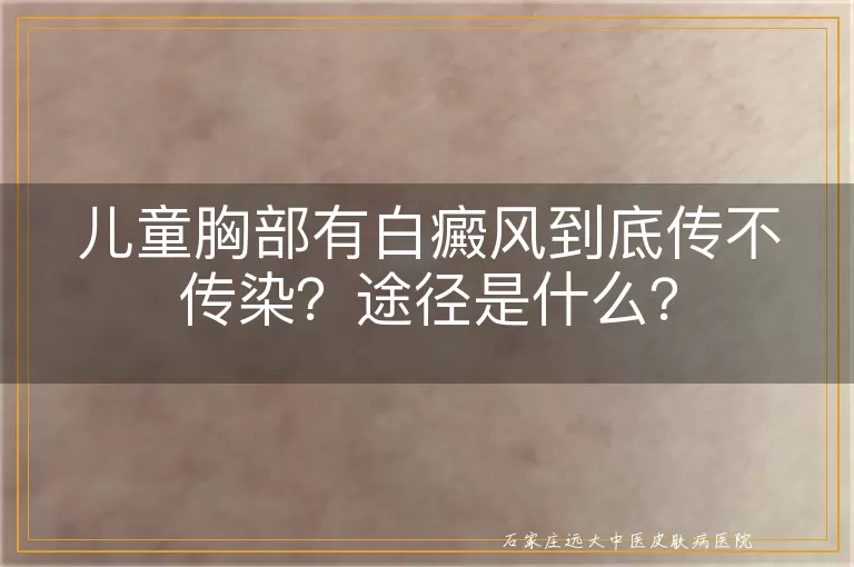 儿童胸部有白癜风到底传不传染？途径是什么？