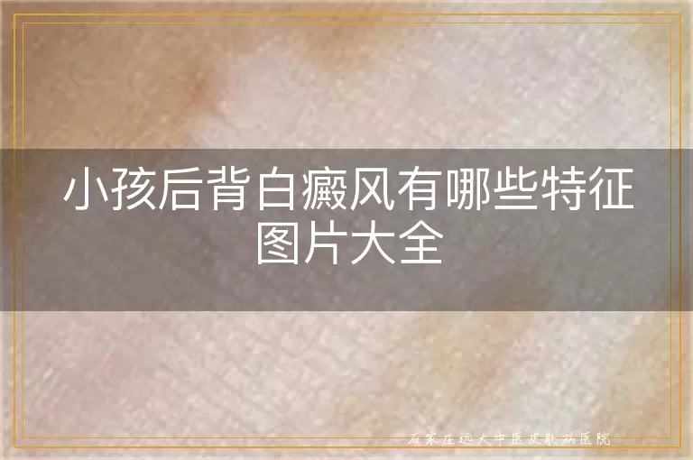 小孩后背白癜风有哪些特征图片大全