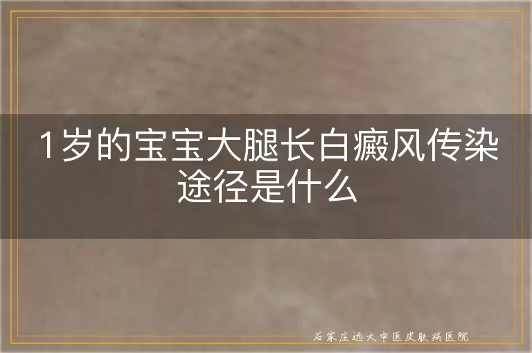 1岁的宝宝大腿长白癜风传染途径是什么