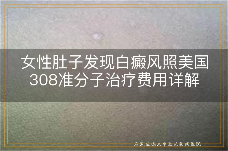 女性肚子发现白癜风照美国308准分子治疗费用详解