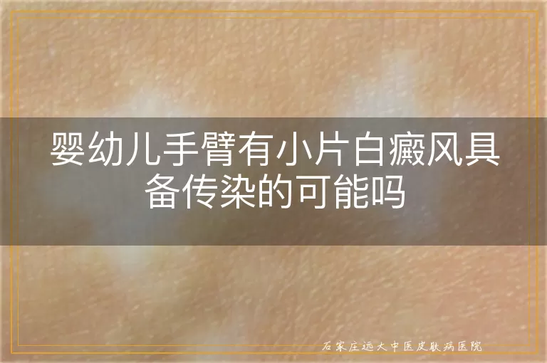 婴幼儿手臂有小片白癜风具备传染的可能吗