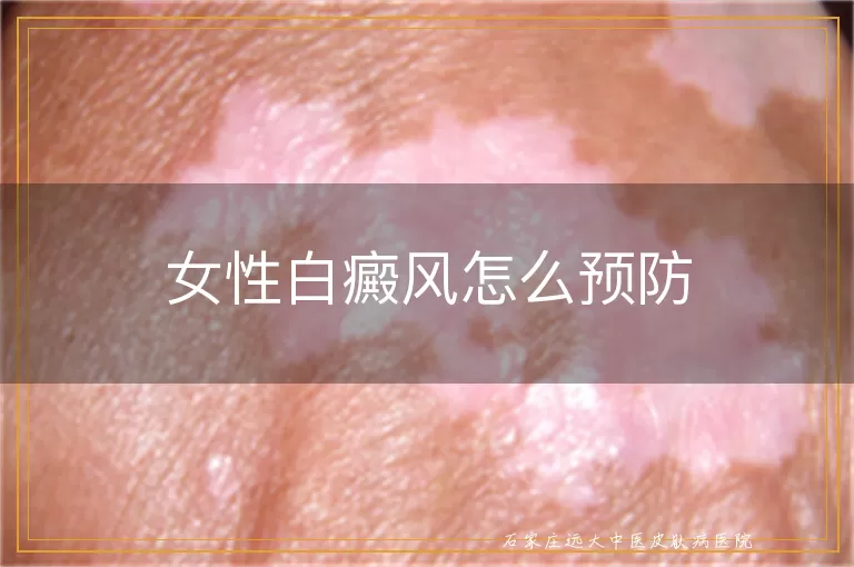 女性白癜风怎么预防