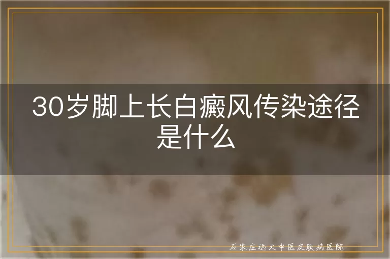 30岁脚上长白癜风传染途径是什么