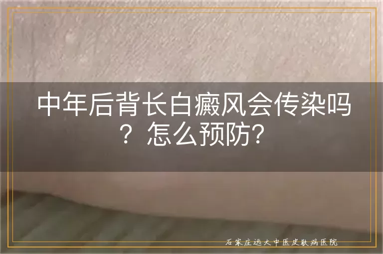 中年后背长白癜风会传染吗？怎么预防？