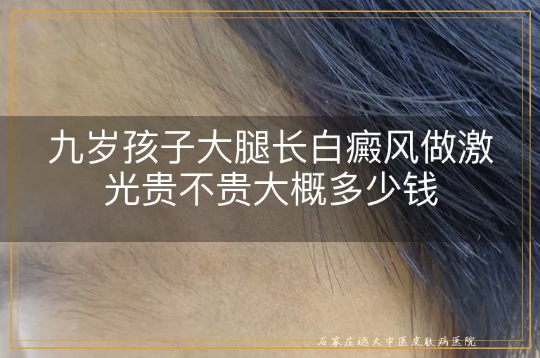 九岁孩子大腿长白癜风做激光贵不贵大概多少钱