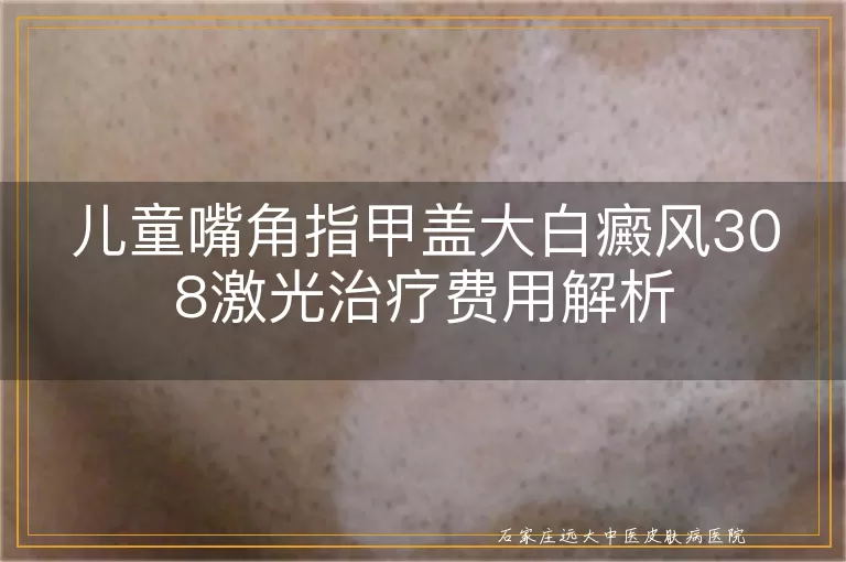 儿童嘴角指甲盖大白癜风308激光治疗费用解析