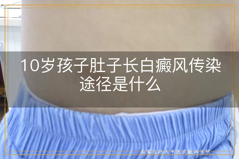 10岁孩子肚子长白癜风传染途径是什么