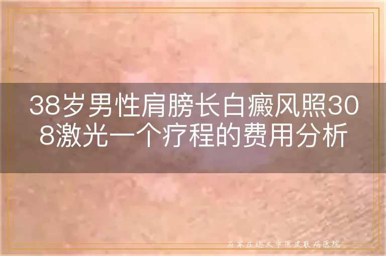 38岁男性肩膀长白癜风照308激光一个疗程的费用分析
