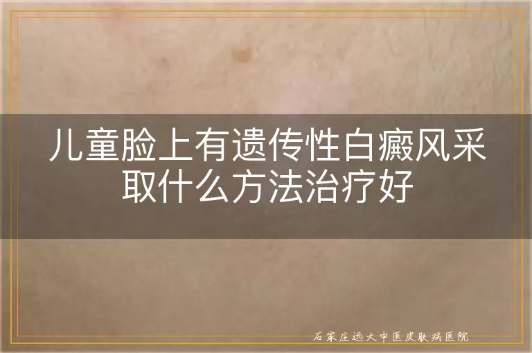 儿童脸上有遗传性白癜风采取什么方法治疗好