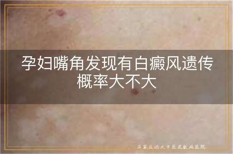 孕妇嘴角发现有白癜风遗传概率大不大