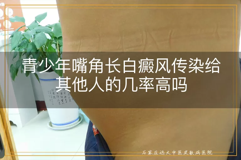 青少年嘴角长白癜风传染给其他人的几率高吗