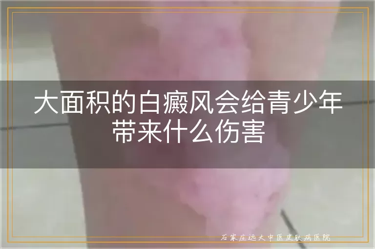 大面积的白癜风会给青少年带来什么伤害