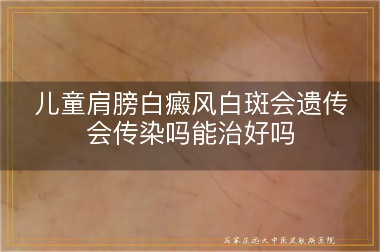 儿童肩膀白癜风白斑会遗传会传染吗能治好吗