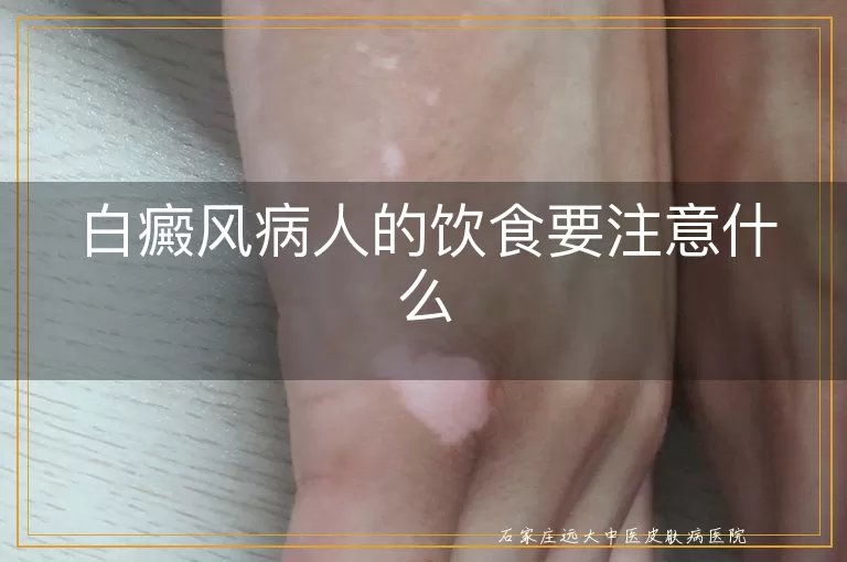 白癜风病人的饮食要注意什么