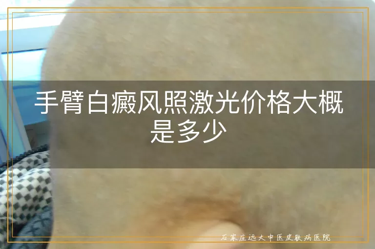 手臂白癜风照激光价格大概是多少