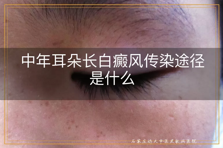 中年耳朵长白癜风传染途径是什么