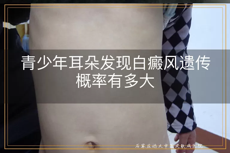青少年耳朵发现白癜风遗传概率有多大