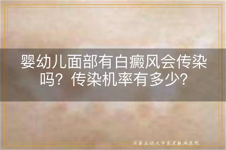 婴幼儿面部有白癜风会传染吗？传染机率有多少？