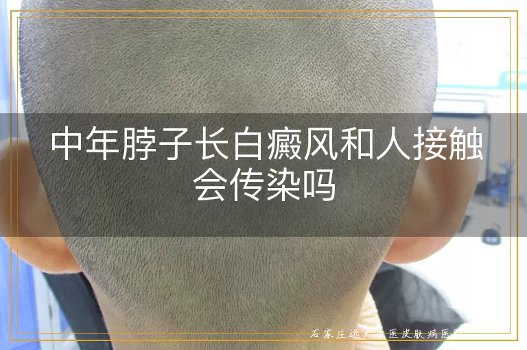 中年脖子长白癜风和人接触会传染吗