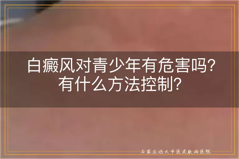 白癜风对青少年有危害吗？有什么方法控制？