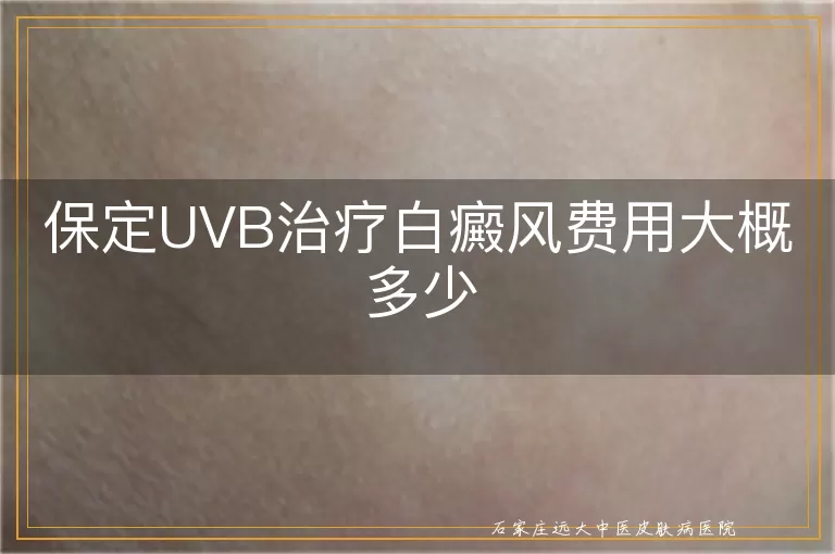 保定UVB治疗白癜风费用大概多少