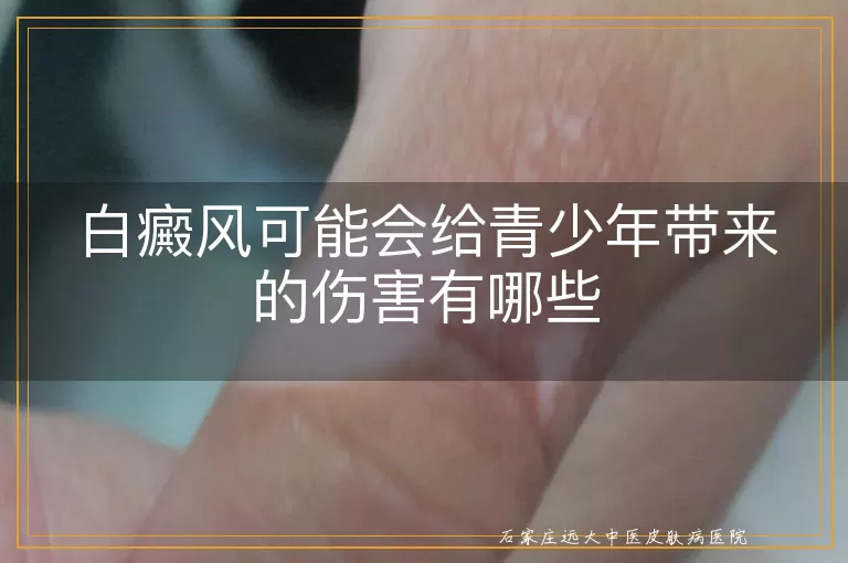 白癜风可能会给青少年带来的伤害有哪些