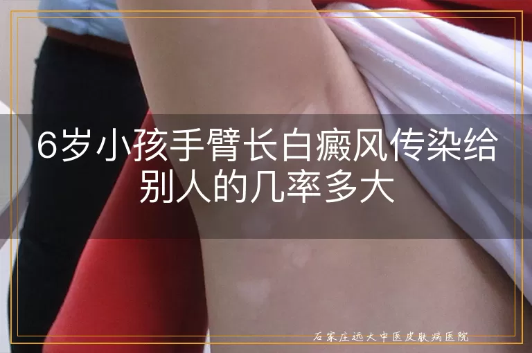 6岁小孩手臂长白癜风传染给别人的几率多大