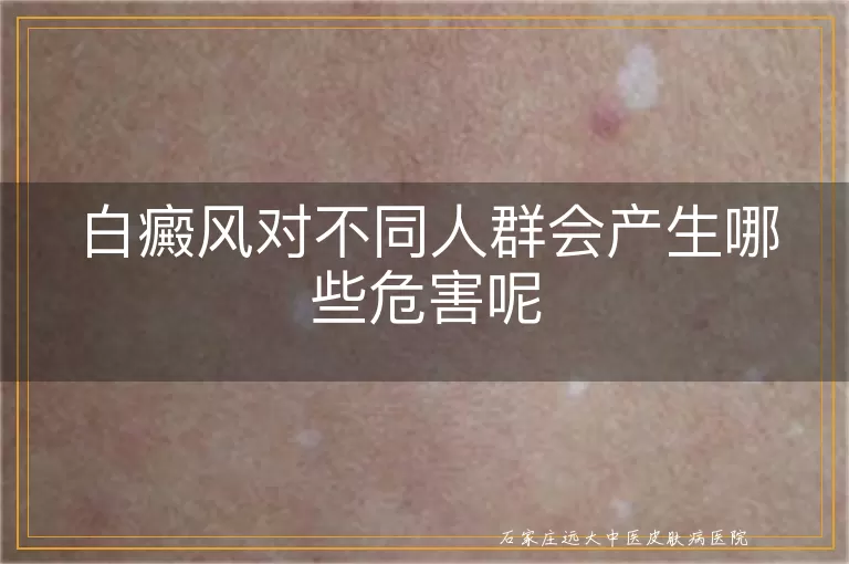 白癜风对不同人群会产生哪些危害呢