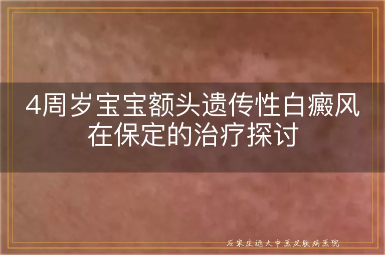 4周岁宝宝额头遗传性白癜风在保定的治疗探讨