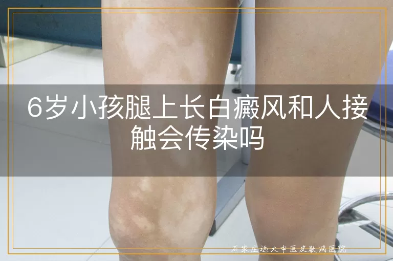 6岁小孩腿上长白癜风和人接触会传染吗
