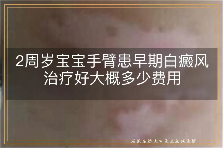 2周岁宝宝手臂患早期白癜风治疗好大概多少费用