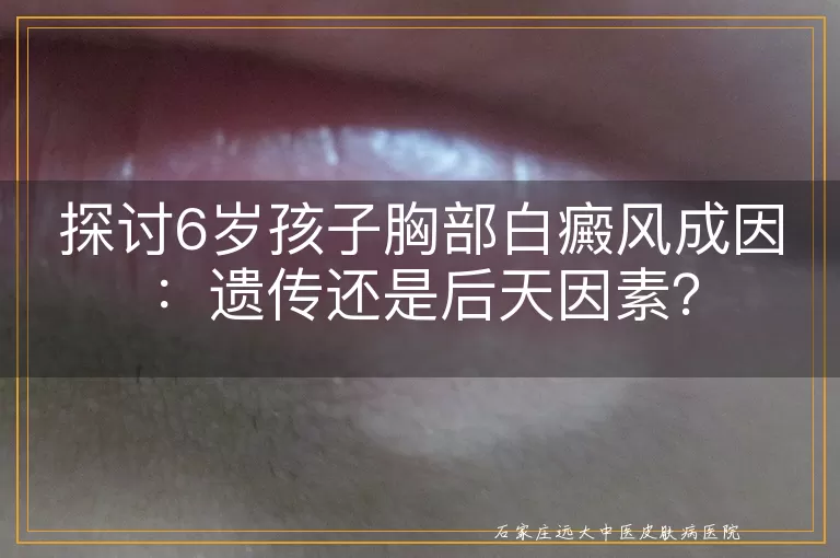 探讨6岁孩子胸部白癜风成因：遗传还是后天因素？