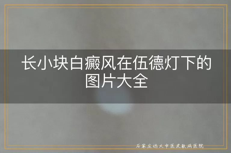 长小块白癜风在伍德灯下的图片大全