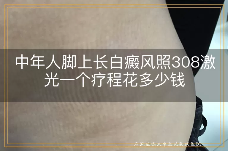 中年人脚上长白癜风照308激光一个疗程花多少钱