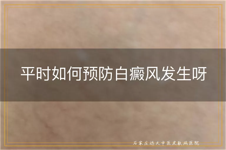 平时如何预防白癜风发生呀