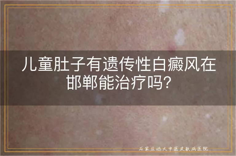 儿童肚子有遗传性白癜风在邯郸能治疗吗？