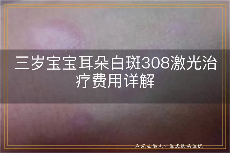 三岁宝宝耳朵白斑308激光治疗费用详解