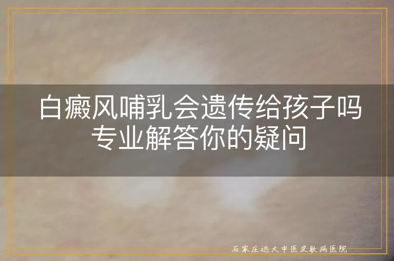 白癜风哺乳会遗传给孩子吗专业解答你的疑问