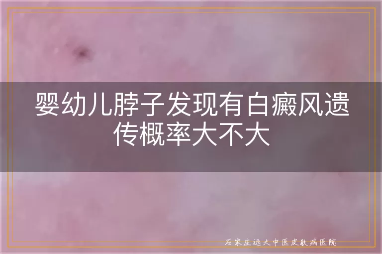 婴幼儿脖子发现有白癜风遗传概率大不大